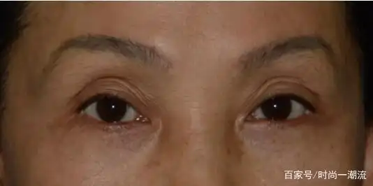 眼窝凹陷怎么改善?我用诗妮菲娅,告别眼窝凹陷!