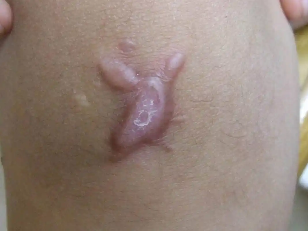 疤痕疙瘩和增生性疤痕在早期两三个月的时候,可能还是不太好分辨的,都