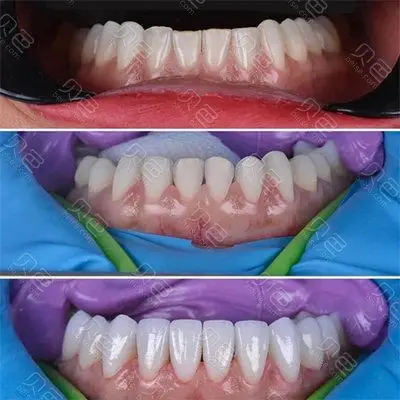 牙齿延长术前后对比