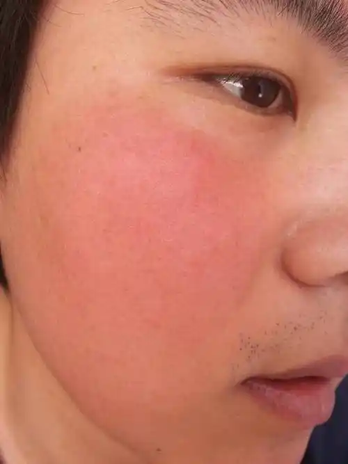 男25岁,脸部脸颊长期发红发热,发红有一年了,发热的时候自己能感觉到