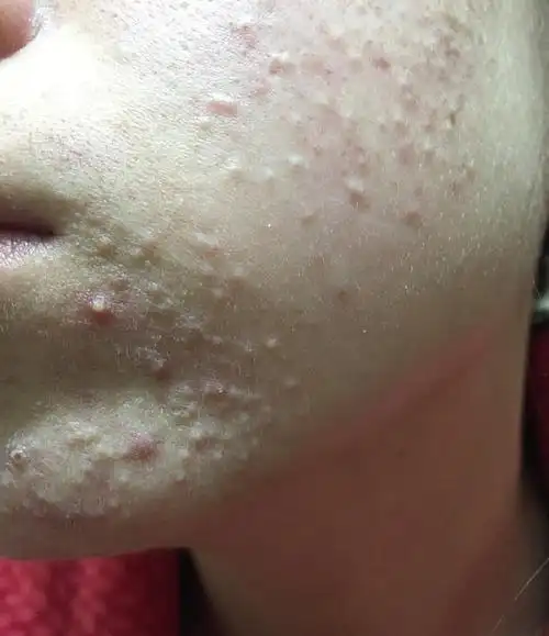 脸上长满闭合型粉刺,医生建议口服异维a酸