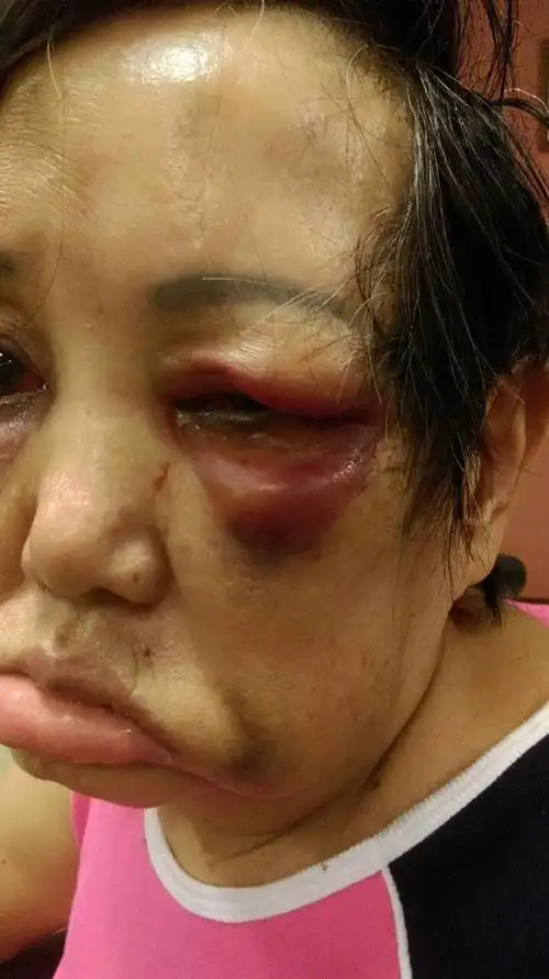 老人家被打得鼻青脸肿.