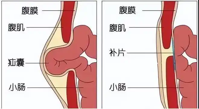75岁老汉肚子为啥大的像怀孕