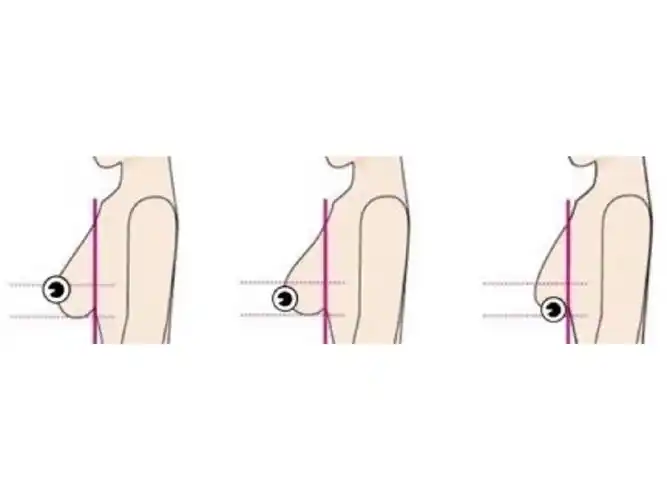 胸位低会不会造成看来像胸部下垂呢?