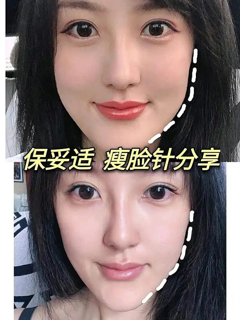 注射瘦脸针后要瘦脸针维持时间长,想问一下打完之.出现效果.