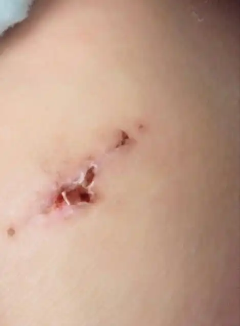 手术刀口变成这样怎么办 还会留疤吗?