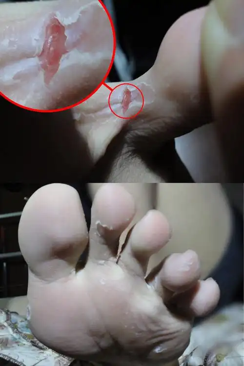 脚趾间脱皮 有点发痒 如图右脚小脚趾和无名脚趾中间最严重点 但不疼