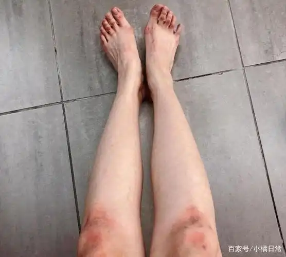 双腿布满的膝盖和脚上满是伤疤,血迹和淤青,可以想象,宣美是段时间为