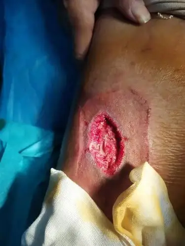 彻底手术清创后看见了漂亮的肉芽