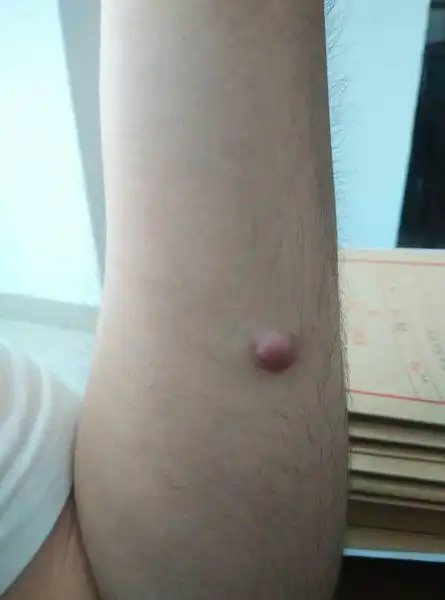我手臂上长了一个圆圆凸起的小肉块 深红色 不知道是什么 好几年了