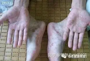 劲爆!什么是体癣"心潮起伏"-第2张图片-维陆网