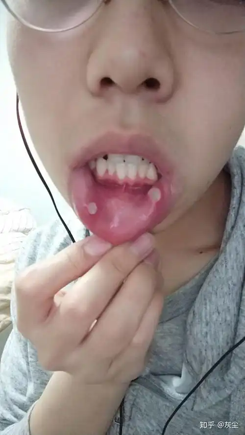 最严重的口腔溃疡