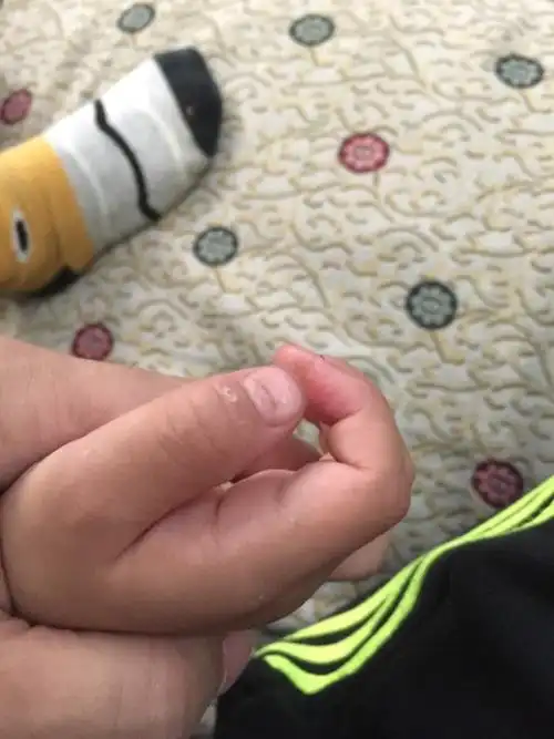 小孩手指甲凹凸不平是什么原因啊?