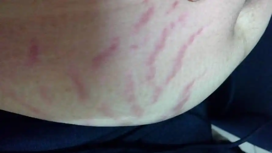 有没有宝妈产后还长妊娠纹的.只看楼主