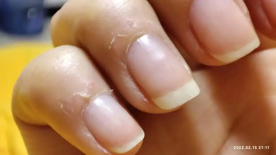 令人窒息的脱皮手指死皮