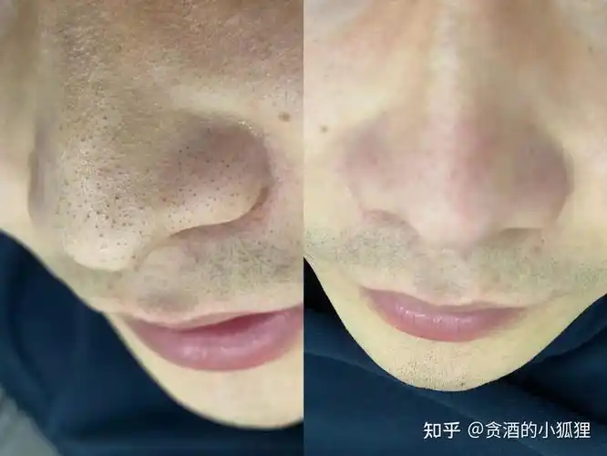 不及时,在毛孔开口的地方堵塞住,混合细菌,皮脂和细胞屑形成"角栓"