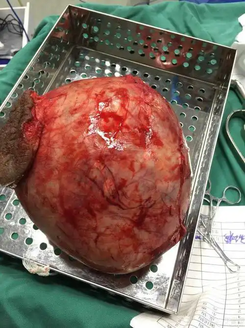 【共享】巨大的睾丸肿瘤 [病例帖]