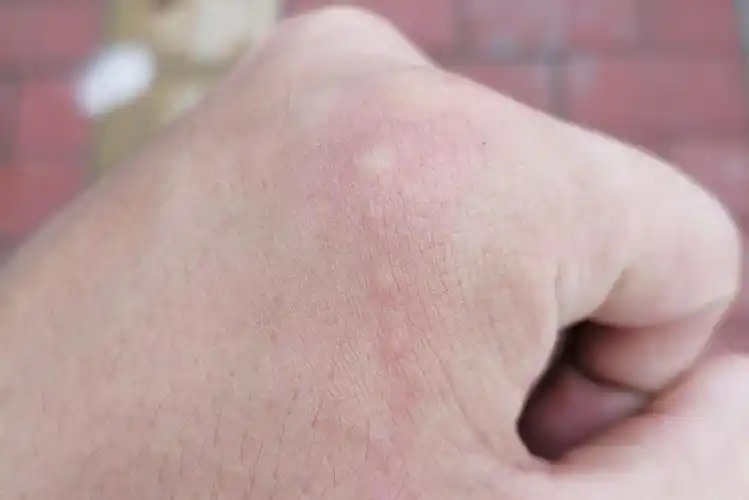 飞蚂蚁咬人后症状