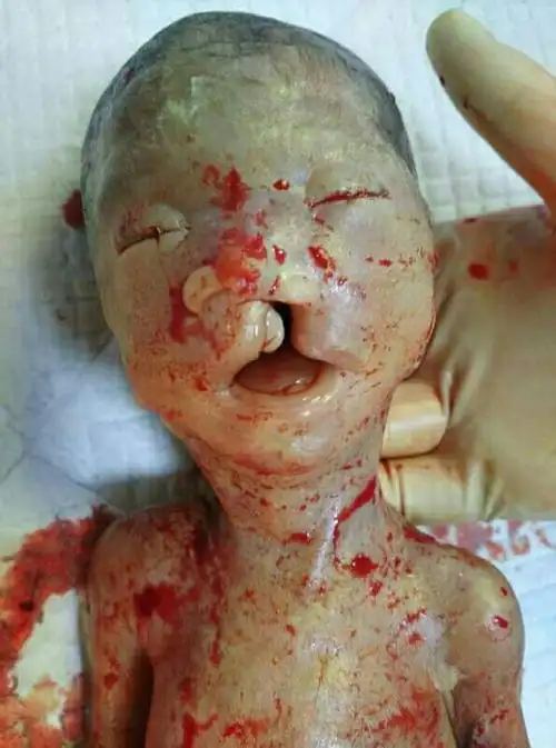 8月5日下午引产出畸形胎儿