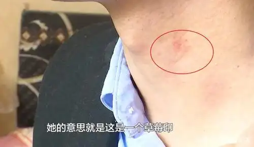 贵阳男子脖子上出现"吻痕",女友一怒之下要分手,男友:冤枉啊