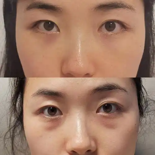 通过几个案例,展示常见的一些眼袋类型和手术方式,包括价格对比,让