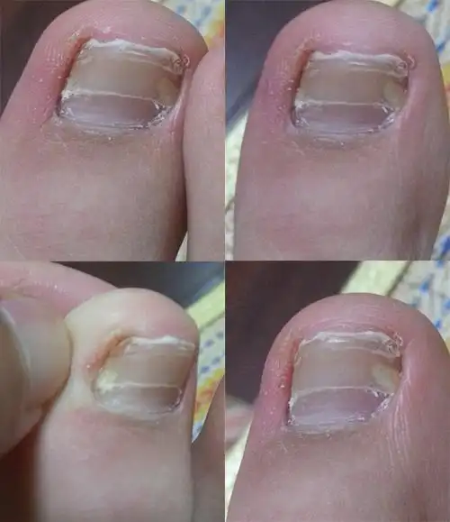 这脚大拇指指甲两截儿地长还有白斑是什么情况,有图.