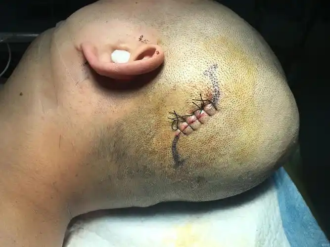 分享一例颞骨凹陷性骨折手术病例(原创)