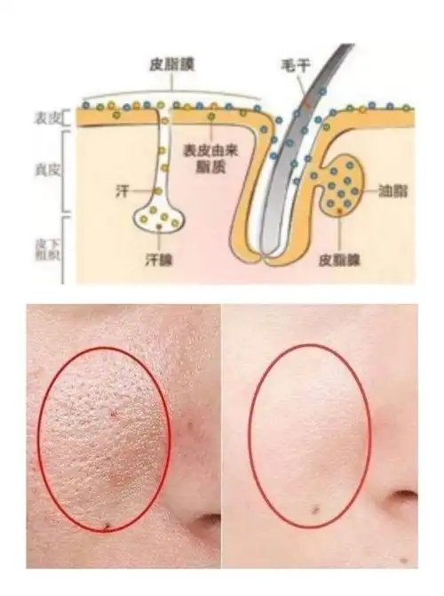 96毛孔粗大一般是因为皮肤弹性变差,毛囊口堵塞,毛囊_圈子-新氧美容