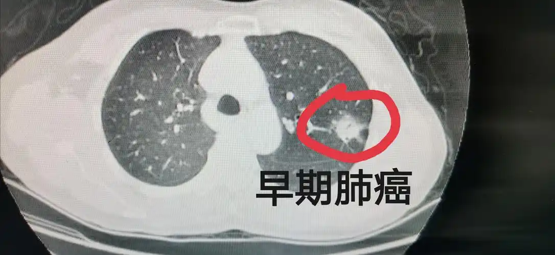 ct——早期发现肺癌的有效方法_肺癌_如何预防_检查 - 好大夫在线