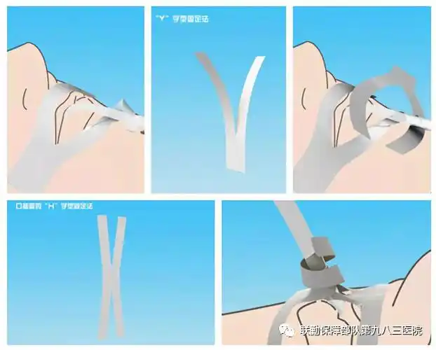 鼻胃管的固定:常见导管的有效固定管路固定要求6.做好宣教工作5.