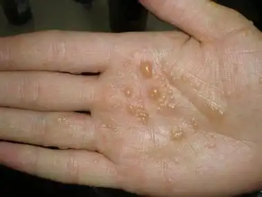 各部位湿疹症状(图)