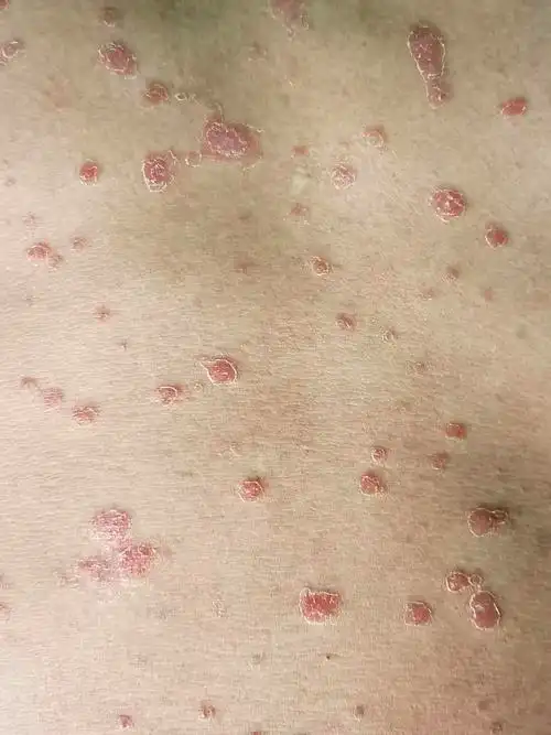 正确对待银屑病_银屑病_症状表现_治疗方式_日常注意事项 - 好大夫