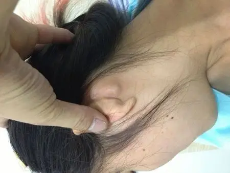 近几天耳朵后面张个包,摸起来有点疼?