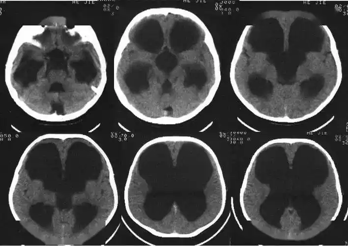脑水肿脑积水的分类及影像表现一文归纳