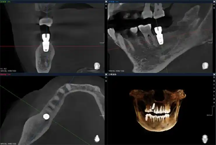 博爵ct国产大视野智能口腔cbctai引领口腔门诊数字化发展