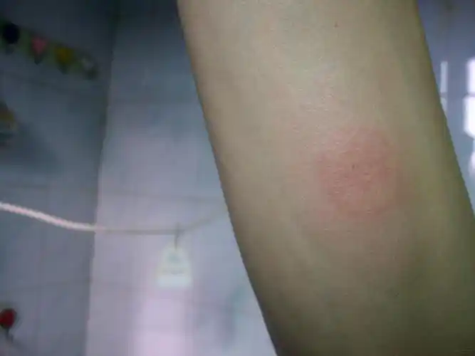 重度皮肤结核病图片