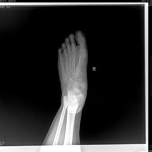 【读片】左足舟骨改变,大家怎么看?