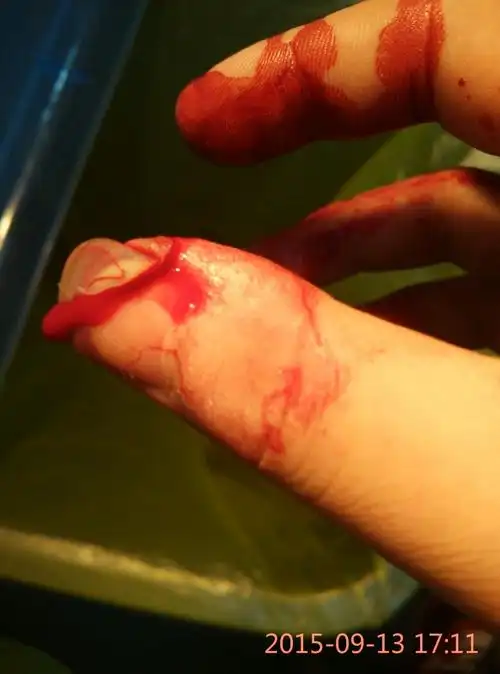 我的手被刀切到了,缝了三针还可不可以上班,要是上班的话手要经常动的