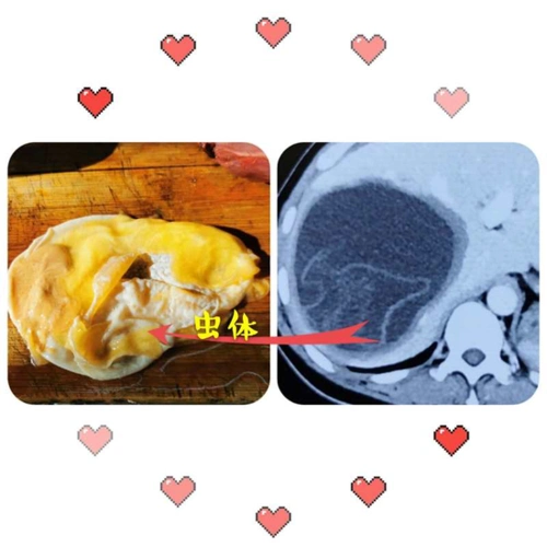 女子爱吃烤肉五分熟竟患罕见肝包虫病哈市一院完整切除排球大小肝占位