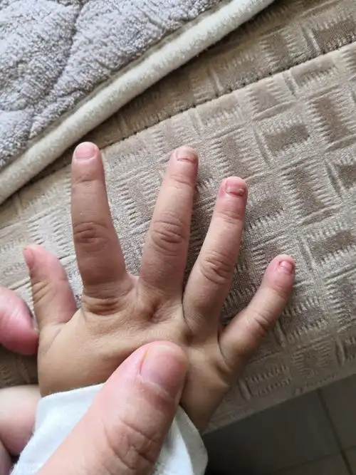 宝宝一岁九个月最近指甲开始脱落