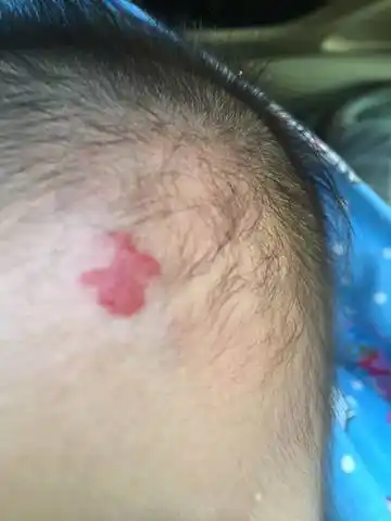 宝宝三个月头上混合型血管瘤怎麼办