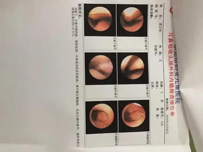 孩子只要感冒,鼻窦炎就会复发,这次又是很黄很笼的鼻涕,孩子今