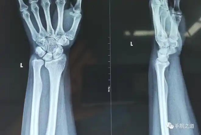 桡骨|尺骨|腕部|月骨_网易新闻