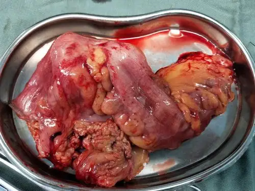 切下来的乙状结肠,瘤体较大,浸透浆膜层!