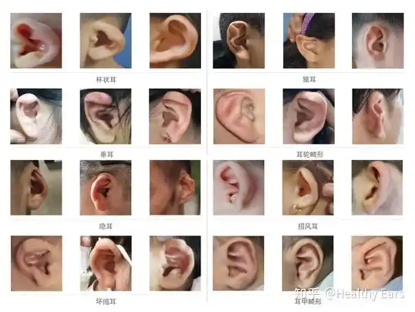 耳廓是五官美学的重要组成部分出现这些情况请注意可能是耳畸形出没