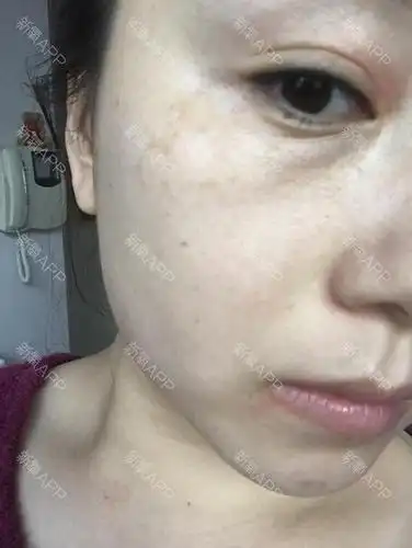 opt激光祛斑第四次(结痂脱落后第三天)不想说什么_圈子-新氧美容整形