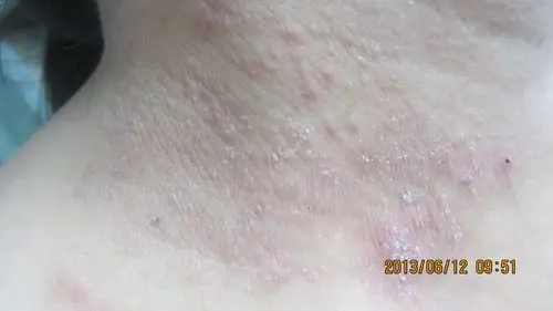 看图诊断神经性皮炎