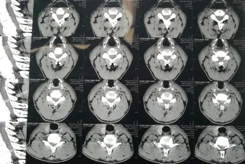 术前ct示c6/7椎体增生伴椎间孔狭窄
