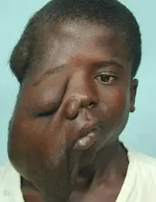 眼眶神经纤维瘤百科