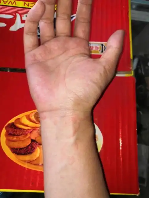 今日份是荨麻疹第九天